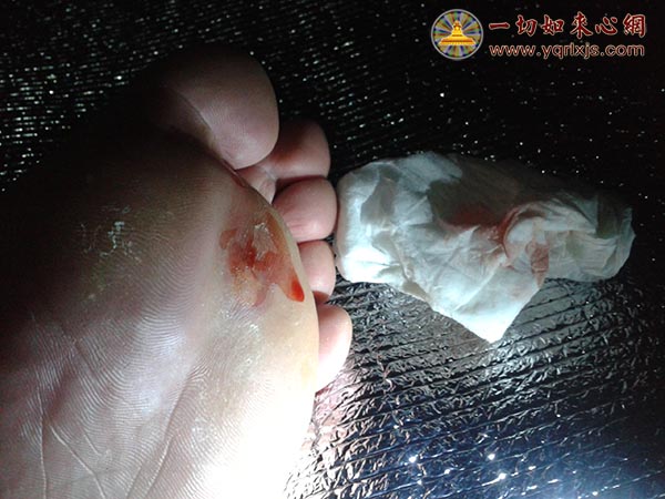 夜晚帐篷中,将脚上的水泡剪破放出血水.南无佛陀耶!